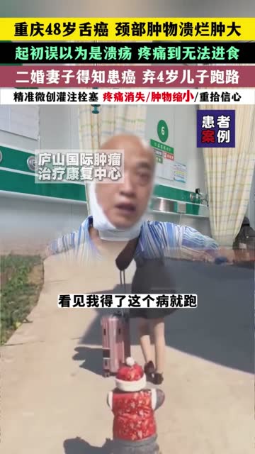重慶舌癌影片畫面
